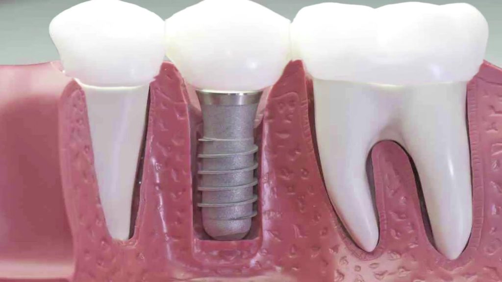 implant-uygulama-1024x576